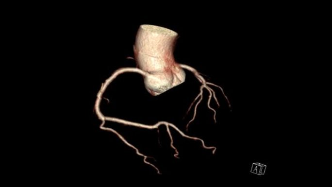 CTA冠状动脉3D渲染显示心脏与血管冠状动脉在屏幕上转身。