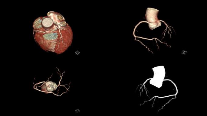 CTA冠状动脉3D渲染显示心脏与血管冠状动脉在屏幕上转身。