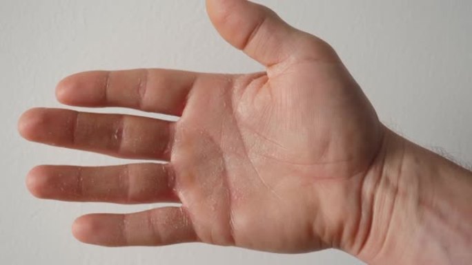 男人手掌干燥皮肤的皮肤病学问题