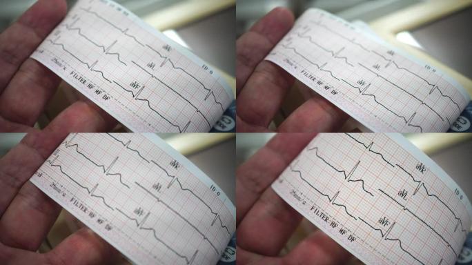 心电记录仪心电报告外国心电指数