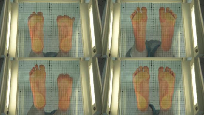 病人站在一个特殊的仪器上，用于确定扁平足。骨科医生评估脚的负荷分布。扁平脚类型的测定。扁平足程度的测