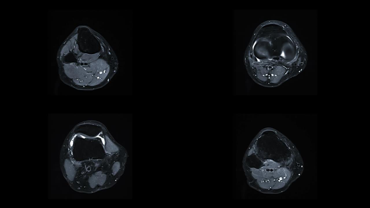 MRI膝关节或磁共振成像对膝关节轴向T2W抑制脂肪。