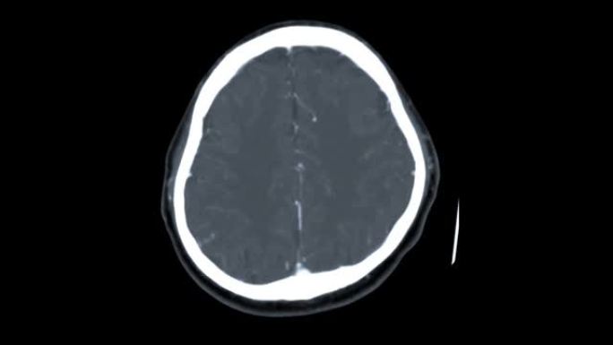 CTA脑轴向MIP视图。