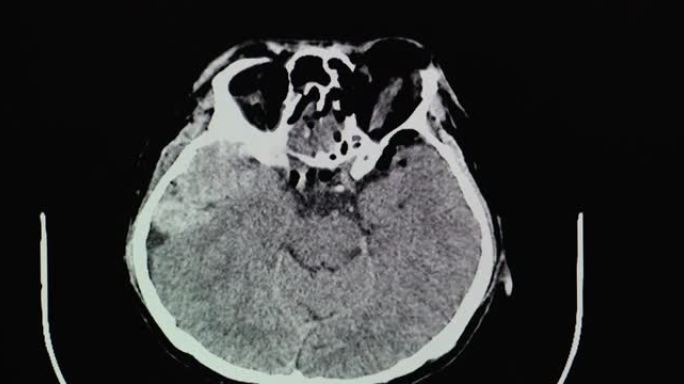 硬膜外血肿意外患者的CT脑部扫描。