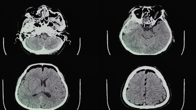硬膜外血肿意外患者的CT脑部扫描。