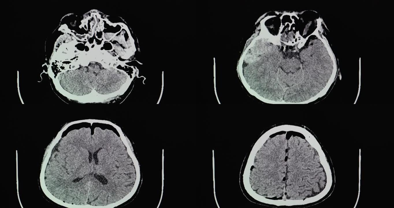 硬膜外血肿意外患者的CT脑部扫描。