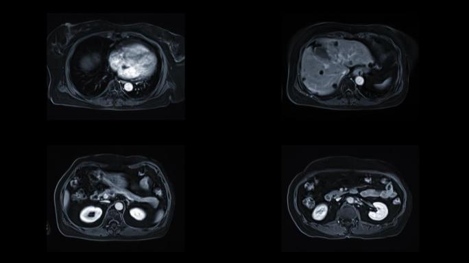 MRI上腹部轴向T2W视图，用于调查疼痛或HCC的原因。