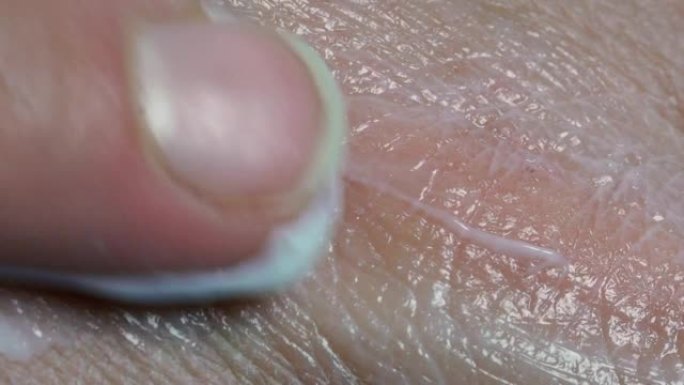 Macro Finger将面霜涂在疤痕上。伤口上的愈合软膏，损伤，手上的面霜应用