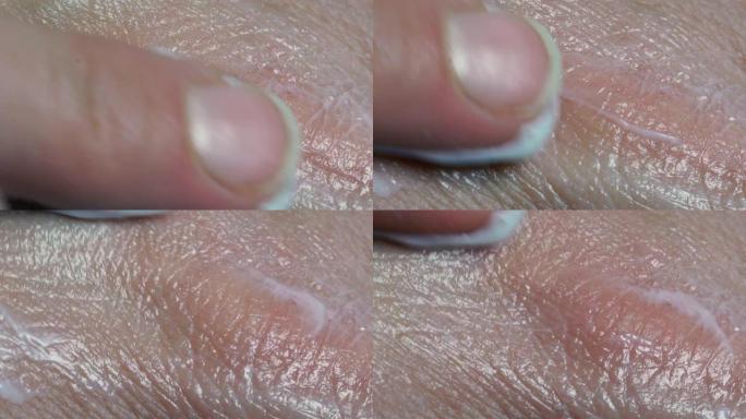 Macro Finger将面霜涂在疤痕上。伤口上的愈合软膏，损伤，手上的面霜应用