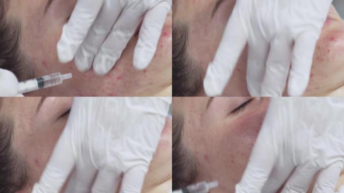 医生给病人涂了一种特殊的凝胶。年轻女子脸上的抗痤疮疗法。美容诊所的面部皮肤治疗