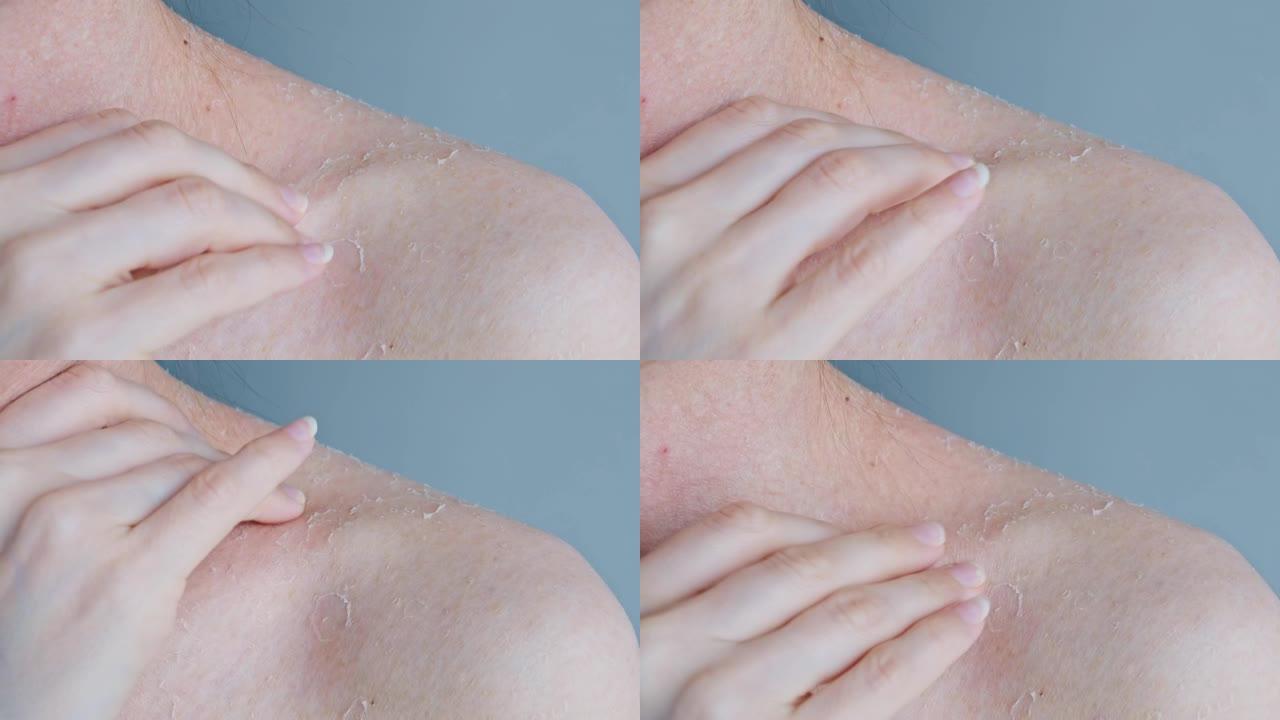 受损皮肤发痒。女人用指甲划伤了肩膀上的皮肤，上面布满了痂，干燥的皮肤脱落了。皮肤问题。身体护理。特写