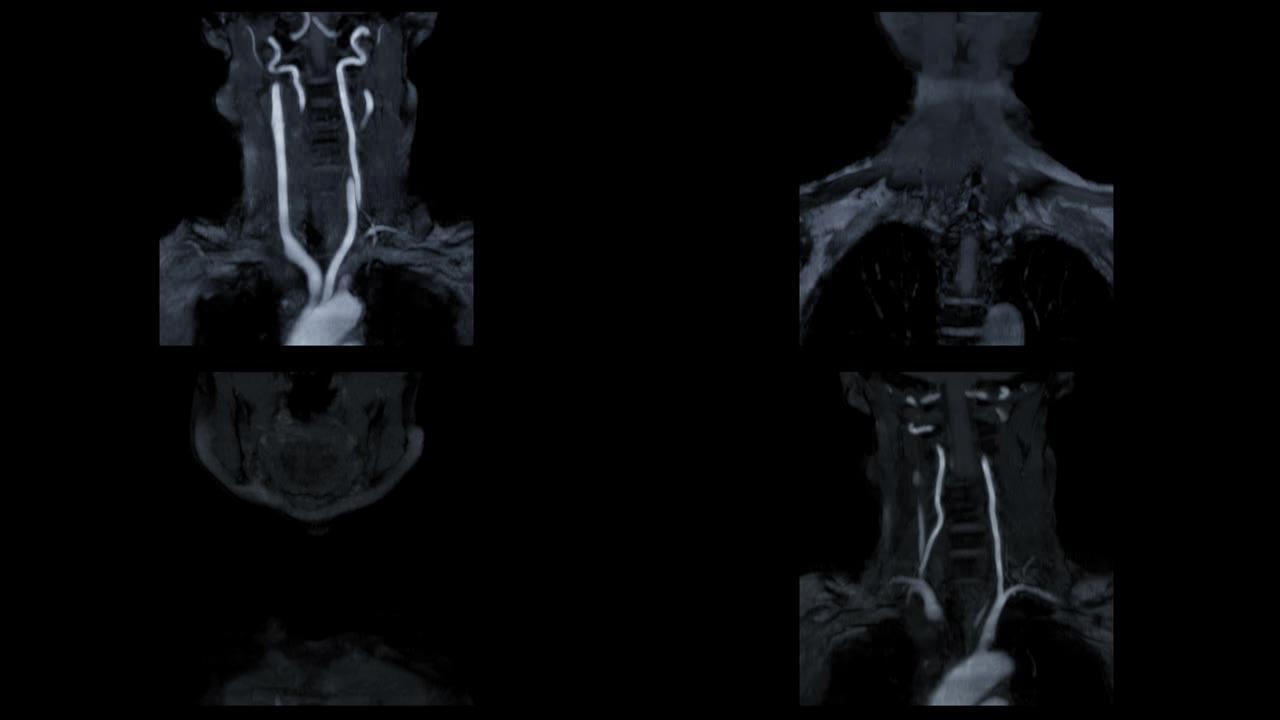 MRA颈动脉技术显示颈总动脉的飞行时间 (TOF)。
