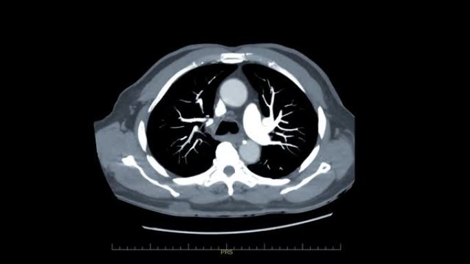 CTA胸部与造影剂轴向MIP视图用于诊断肺栓塞 (PE) 和肺癌。