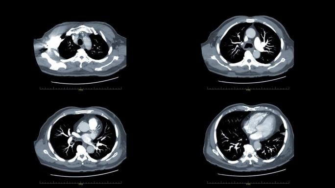 CTA胸部与造影剂轴向MIP视图用于诊断肺栓塞 (PE) 和肺癌。