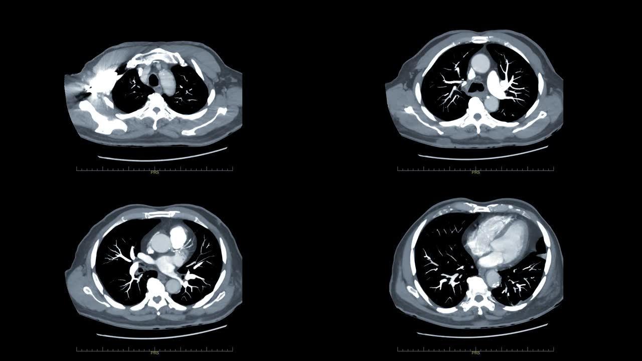 CTA胸部与造影剂轴向MIP视图用于诊断肺栓塞 (PE) 和肺癌。