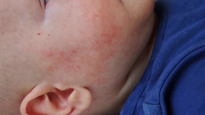 婴儿脸颊上的红色rush丘疹过敏性皮炎