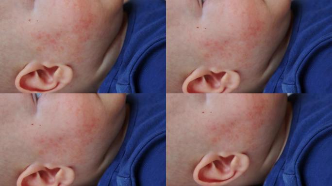 婴儿脸颊上的红色rush丘疹过敏性皮炎