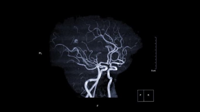 脑动脉MRA或磁共振血管造影。