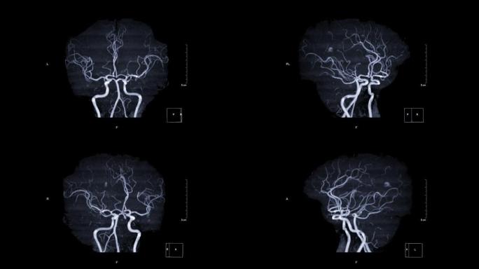 脑动脉MRA或磁共振血管造影。