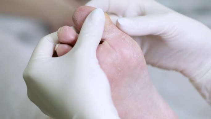 皮肤科医生检查糖尿病患者的脚。有问题的糖尿病足有裂缝和结垢。