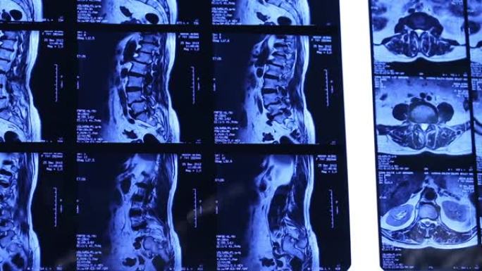 MRI扫描，腰椎股票视频火鸡，腹部，分析，解剖，骨