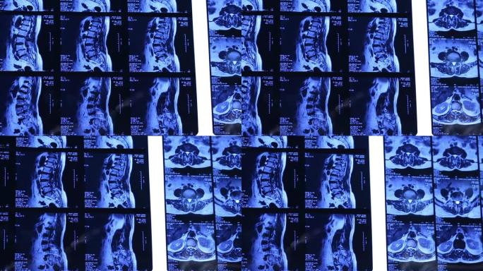MRI扫描，腰椎股票视频火鸡，腹部，分析，解剖，骨
