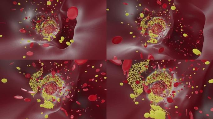血管: 红细胞、胆固醇和斑块