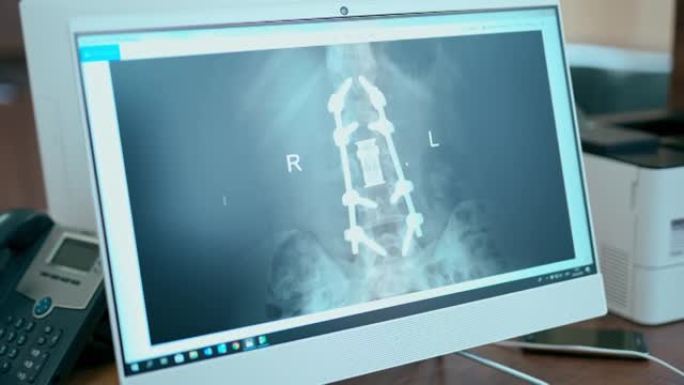 病人的x光扫描。临床屏幕上的x射线图像