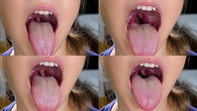 女童张开嘴，用舌头和扁桃体显示喉咙