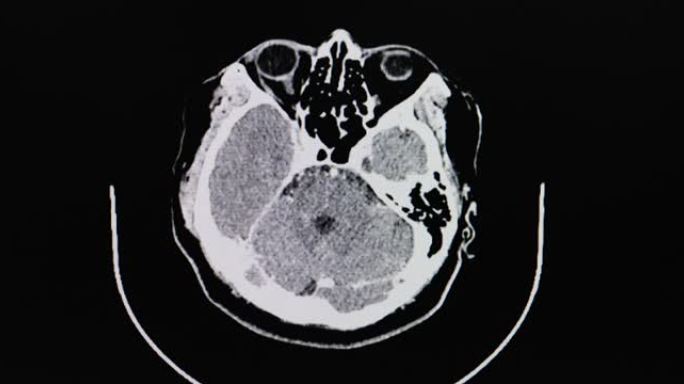 猪链球菌脑膜炎患者大脑的ct扫描
