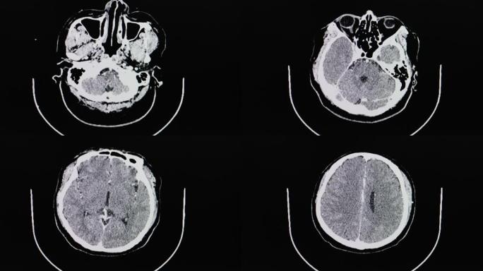 猪链球菌脑膜炎患者大脑的ct扫描