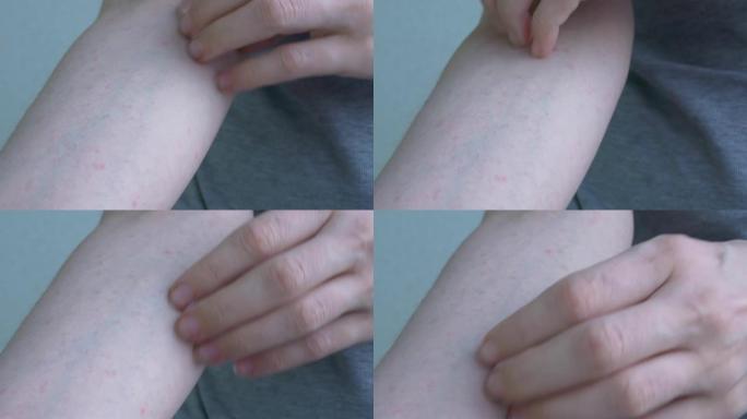 在从肘部到手的间隔中，特写显示皮肤的轻微粉红色炎症。发痒的皮肤被指甲划伤。病毒性疾病。特写