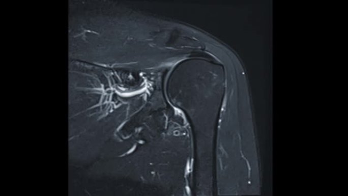 MRI肩关节或磁共振成像肩关节冠状动脉T2W诊断关节炎，包括撕裂和撞击。