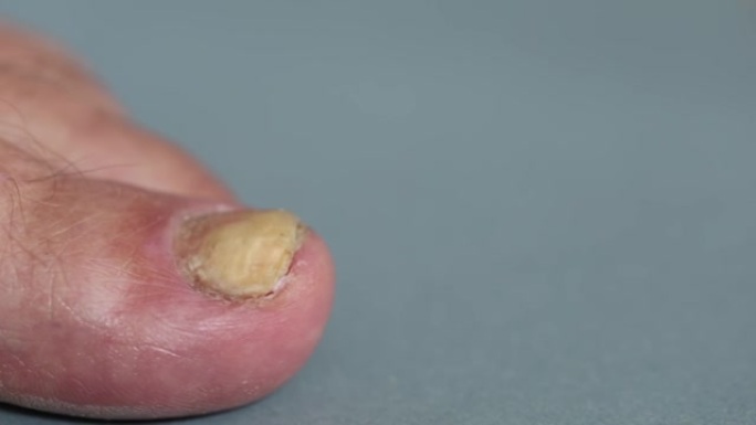 相机用受真菌影响的拇指指甲沿脚移动
