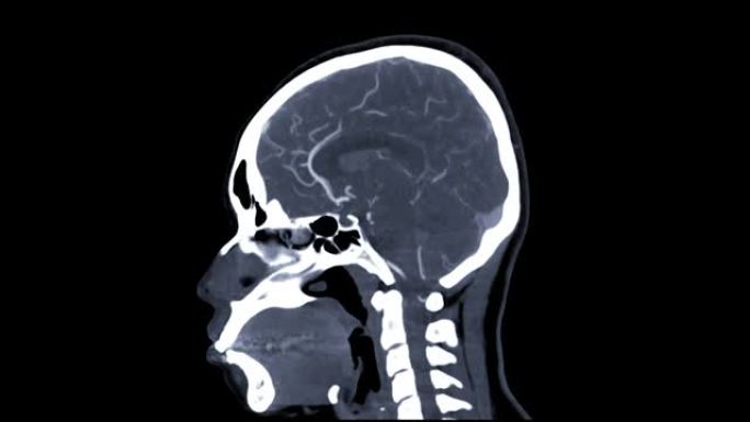 CTA脑或计算机断层扫描血管造影的脑矢状面视图。