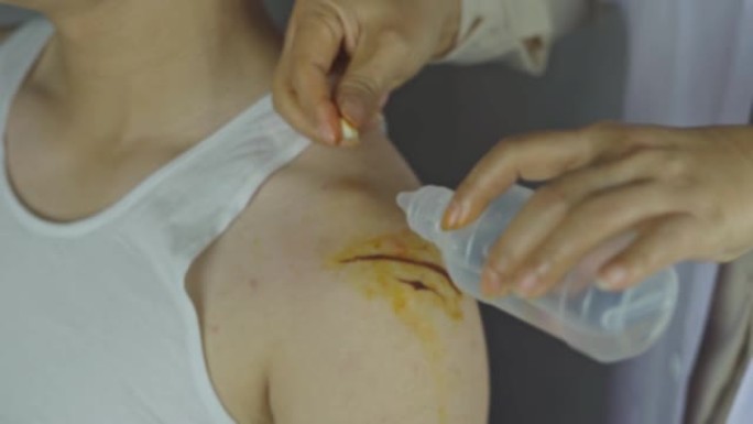 医生用棉球和敷料清洁肩部伤口，伤口护理过程