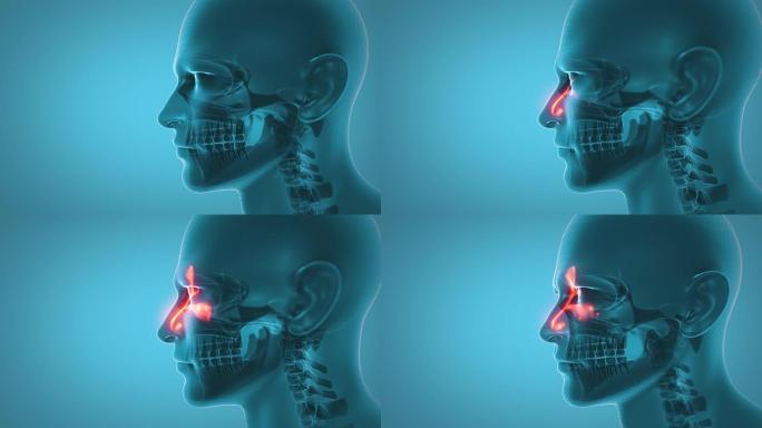 鼻窦炎鼻窦炎医疗保健和医学