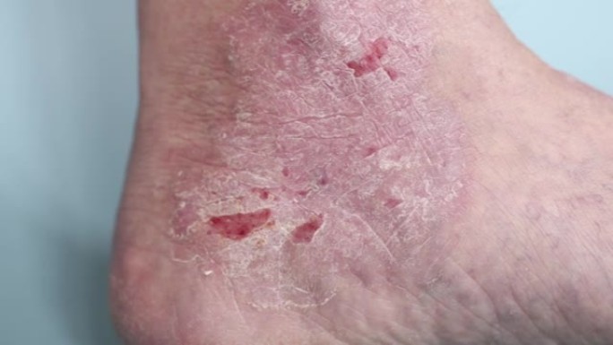 银屑病。脚划伤区域，受银屑病斑块影响