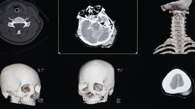 脑外伤患者的CT电影扫描显示脑出血。