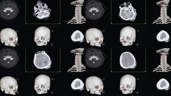 脑外伤患者的CT电影扫描显示脑出血。