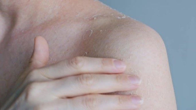 一名妇女用指甲划伤肩膀上的皮肤，指甲上覆盖着结痂，瘙痒的皮肤受损，干燥的皮肤剥脱。皮肤问题。身体护理