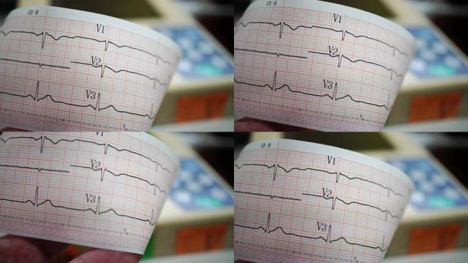 心电记录仪胎心监测图纸视频素材