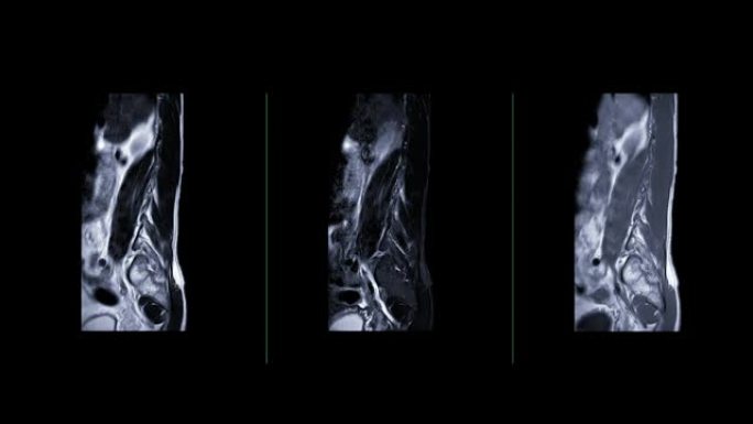 MRI l-s脊柱或腰椎矢状面比较T1W FS、T2W和T1后注射钆造影剂技术诊断脊髓压迫。