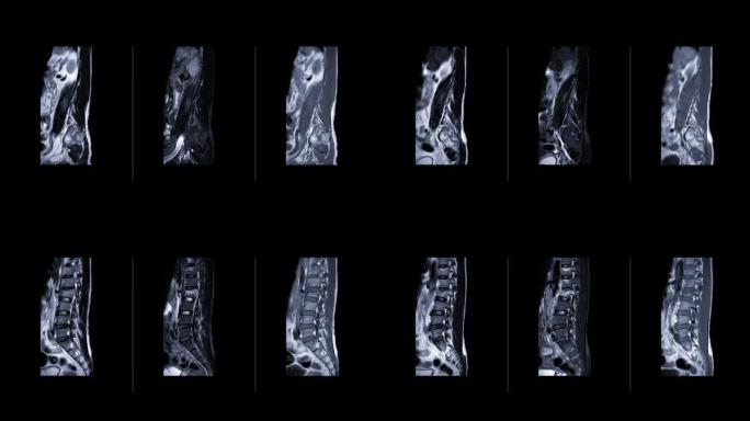 MRI l-s脊柱或腰椎矢状面比较T1W FS、T2W和T1后注射钆造影剂技术诊断脊髓压迫。