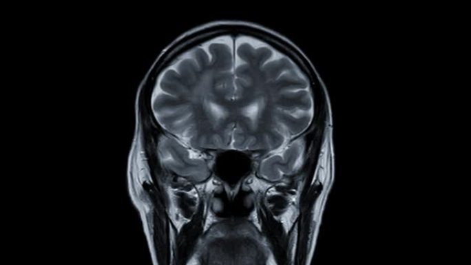 MRI脑冠状T2W技术检测中风病。