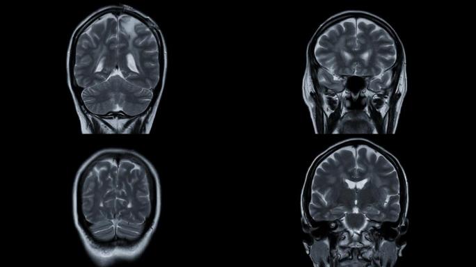 MRI脑冠状T2W技术检测中风病。