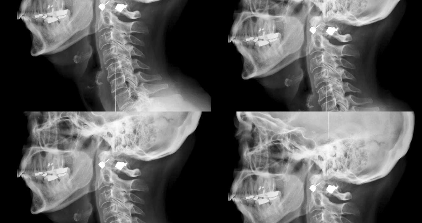 人体颈部和头部的x射线