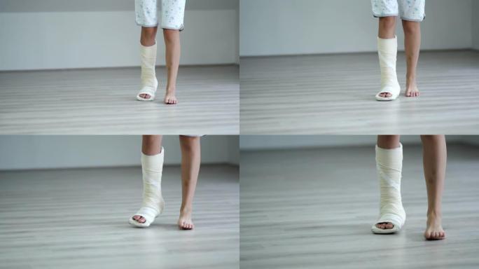 女人断腿的特写石膏模型试图走路，腿伤后康复的概念