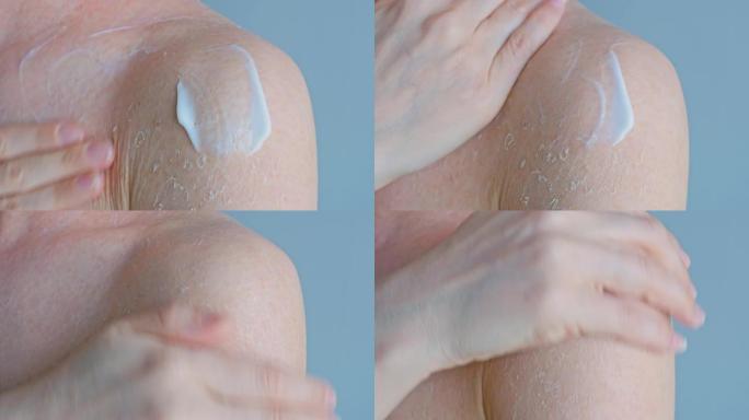 一名妇女在裸露的肩膀上涂抹乳霜，皮肤上布满了裂缝和水泡。皮肤问题。身体护理。特写