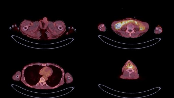 PET CT (正电子发射断层扫描) 全身三维渲染图像红色色调轴视，用于检测肿瘤术后复发。